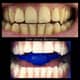 Slider image (9) Zirve Dental Marmaris